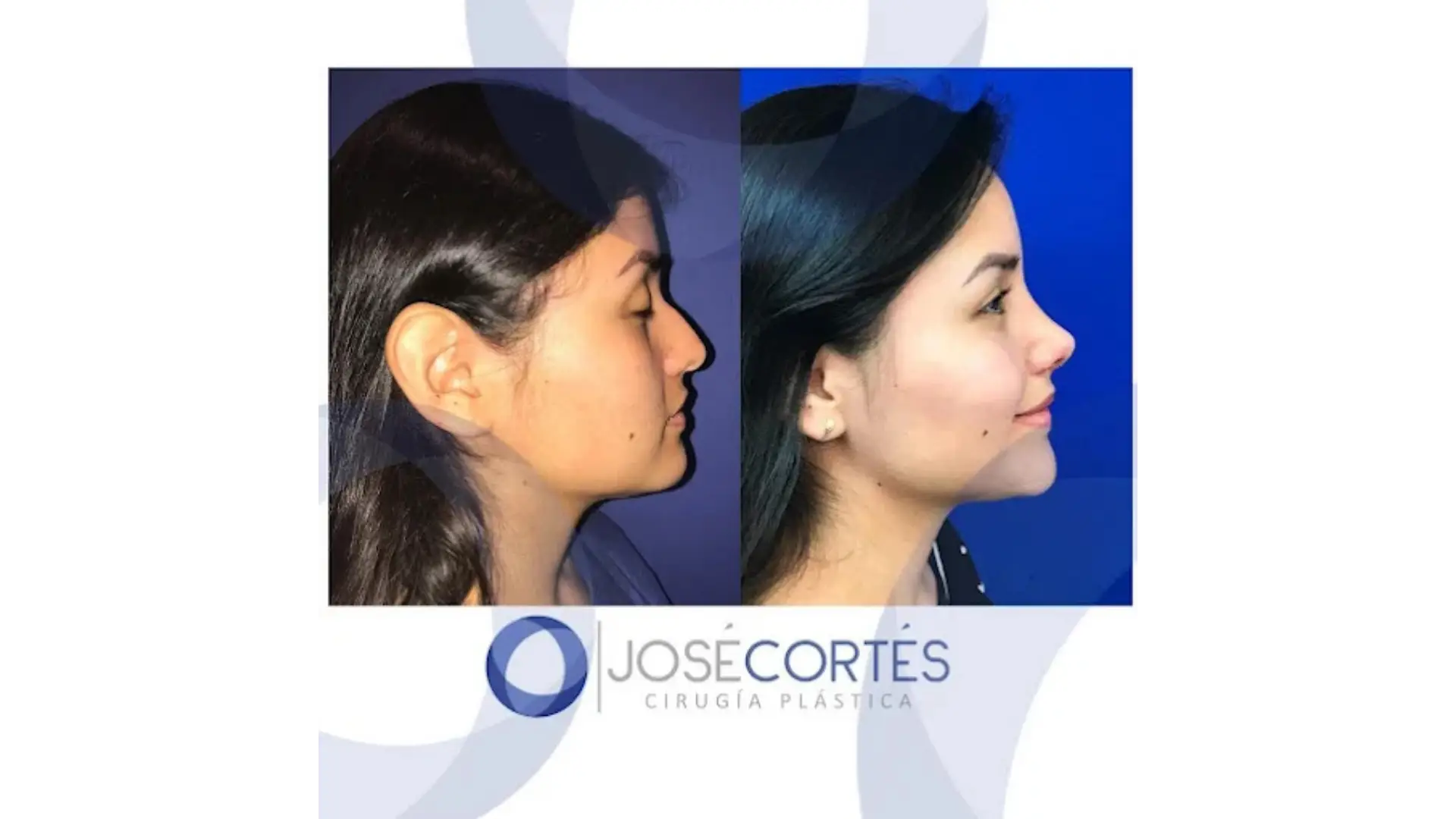 Rhinoplasty in Mexico City, Mexico by Jose Cortes Institute