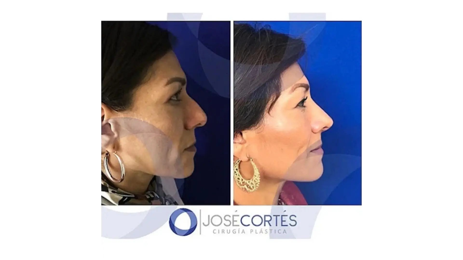 Rhinoplasty in Mexico City, Mexico by Jose Cortes Institute