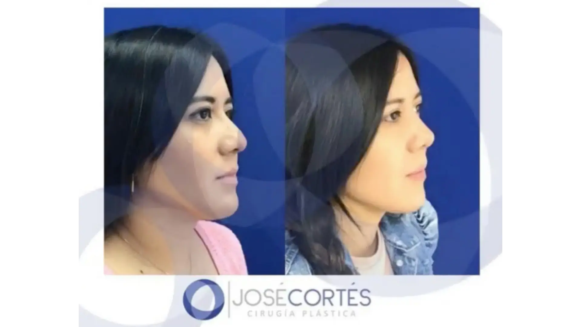 Rhinoplasty in Mexico City, Mexico by Jose Cortes Institute