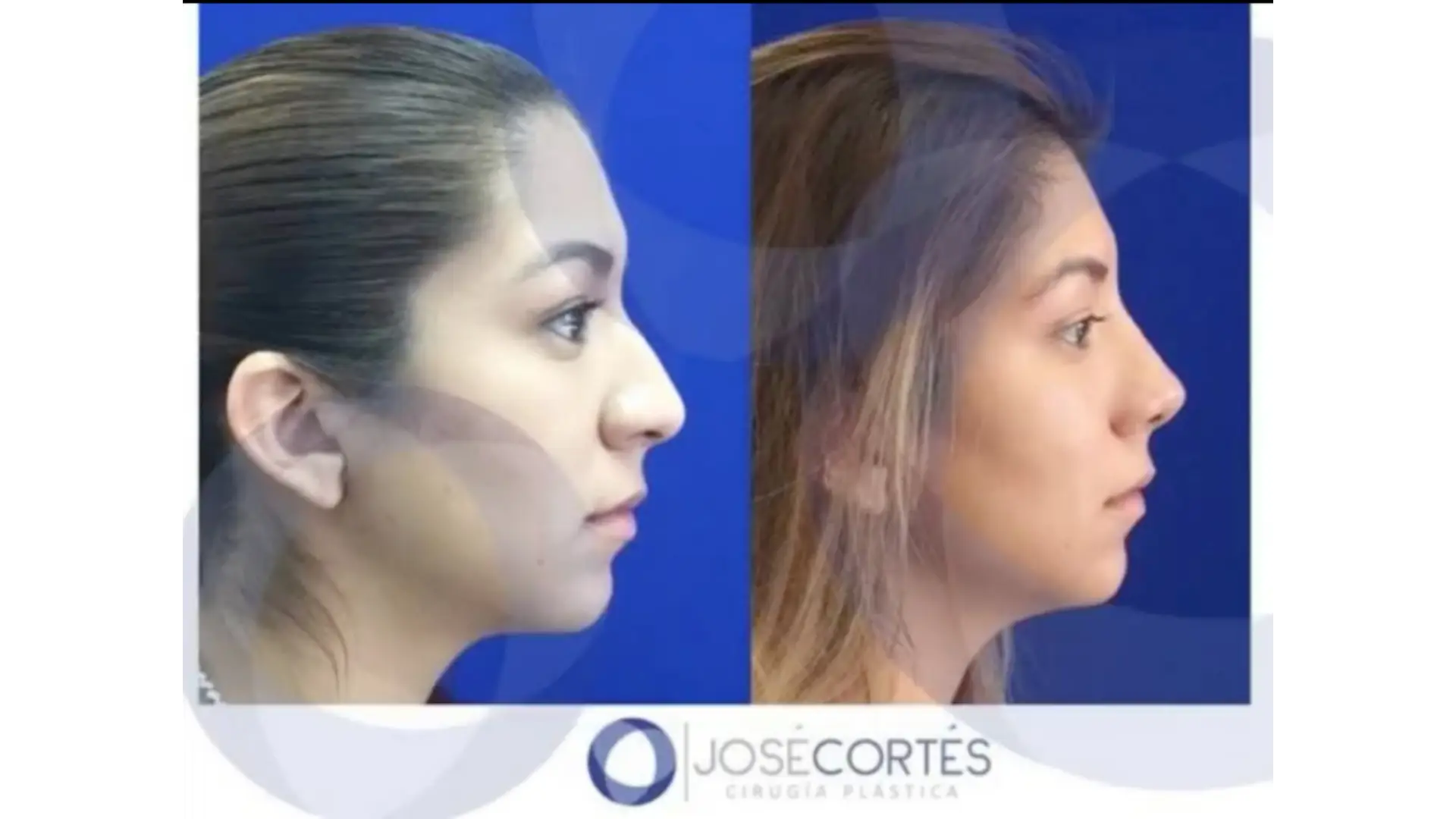 Rhinoplasty in Mexico City, Mexico by Jose Cortes Institute