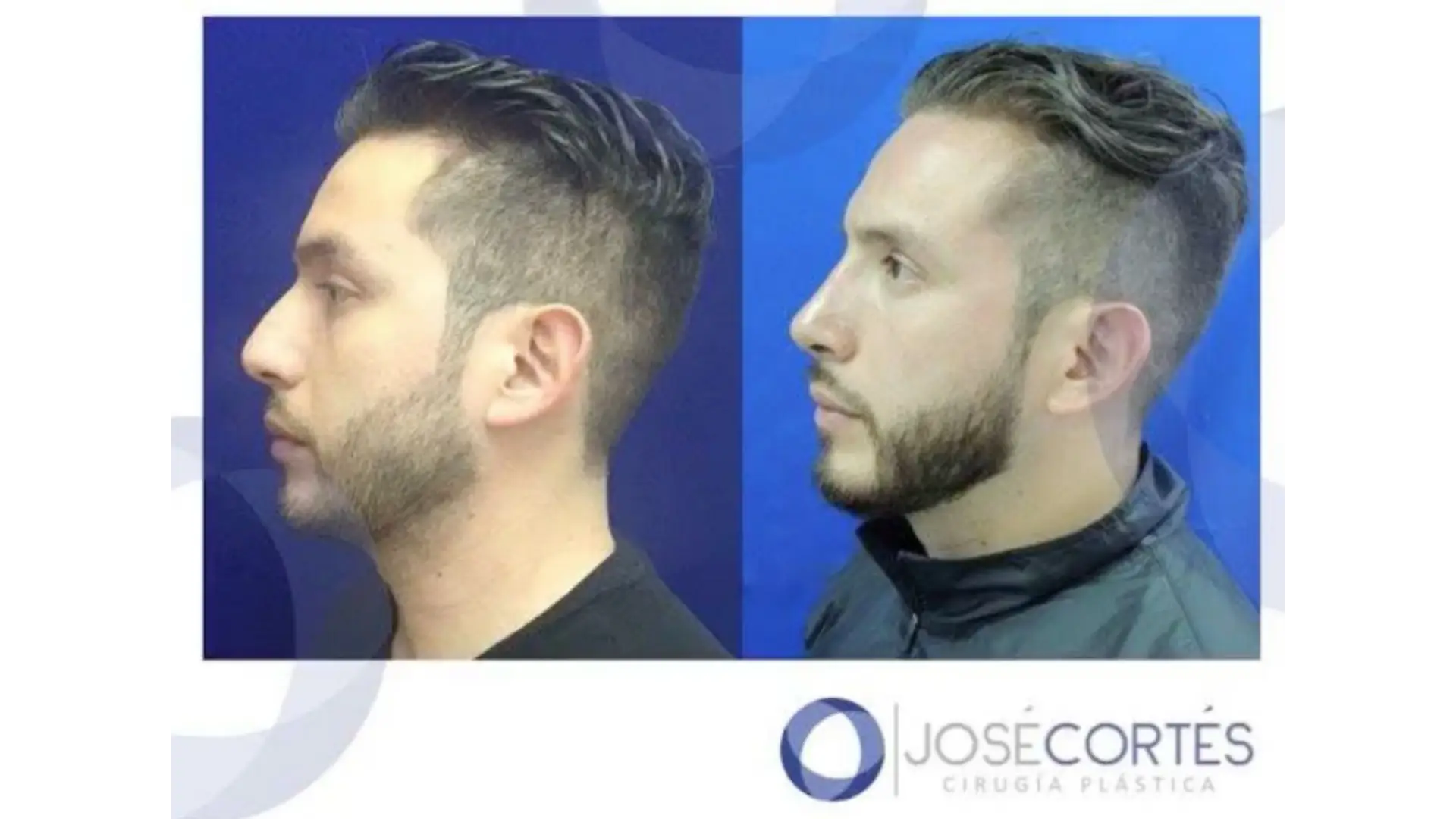 Rhinoplasty in Mexico City, Mexico by Jose Cortes Institute