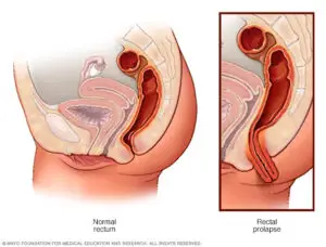 Correction of Anal Prolapse in São Paulo, Brazil by Kaiser Clínica
