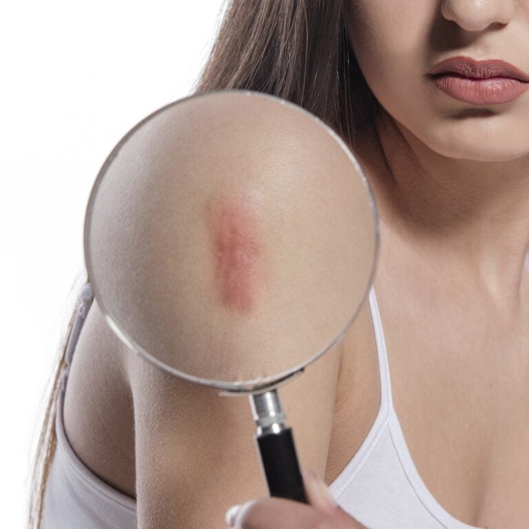 Scar Treatment in Mexico City, Mexico by Jose Cortes Institute