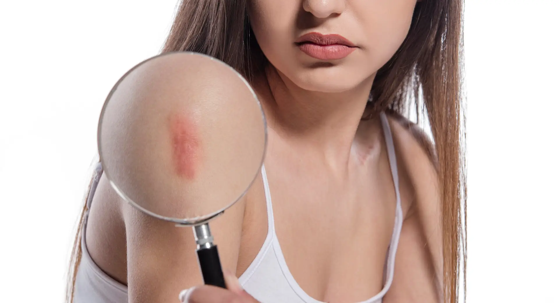 Scar Treatment in Mexico City, Mexico by Jose Cortes Institute — Procedure Gallery Photo