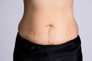 Stretch Marks Removal Clinics and Procedures Abroad