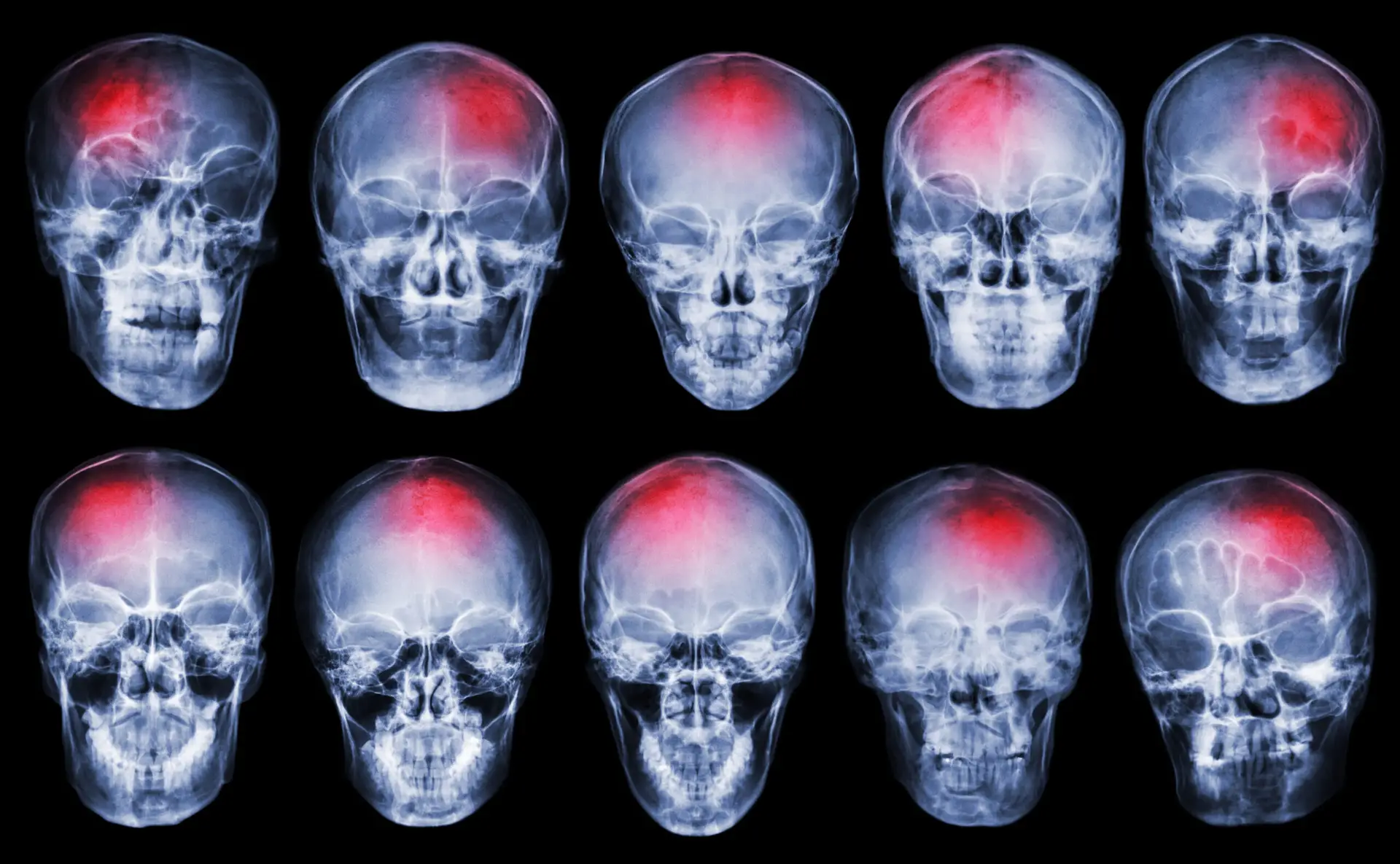 Stroke Treatment with Stem Cells in Malacky, Slovakia by CellCenter Slovakia