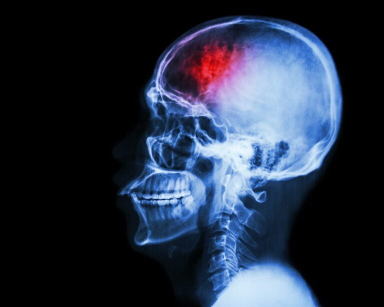 Stroke Treatment with Stem Cells in Malacky, Slovakia by CellCenter Slovakia