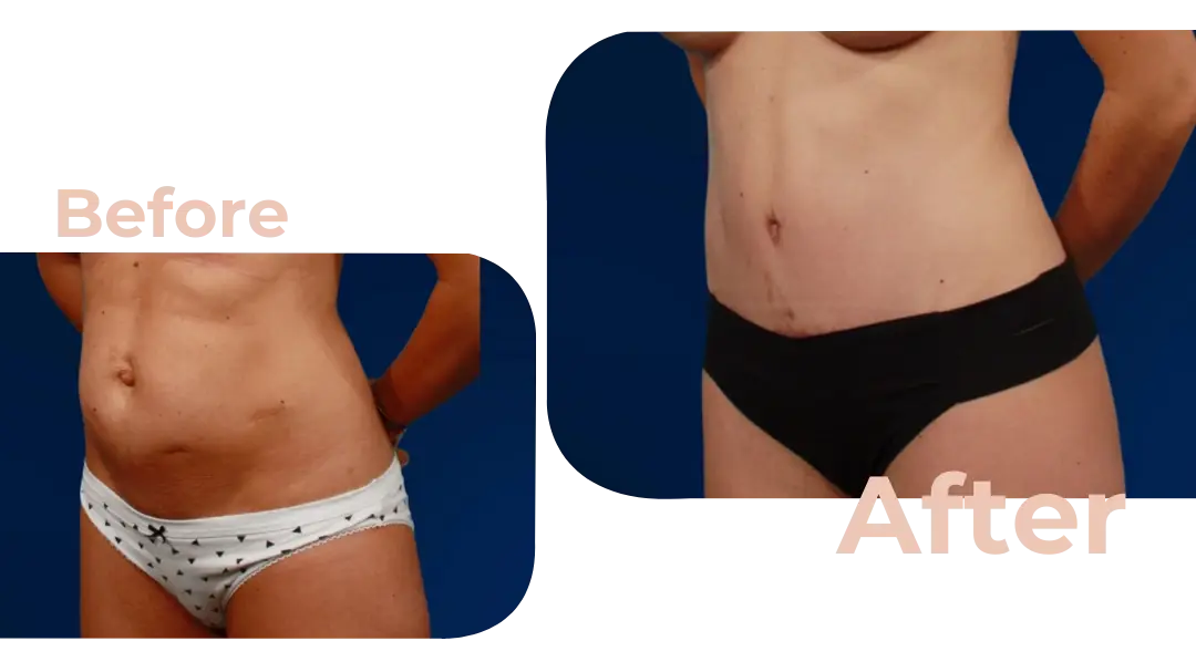 Tummy Tuck (Abdominoplasty) Surgery in Istanbul, Turkey by Avicenna Hospital