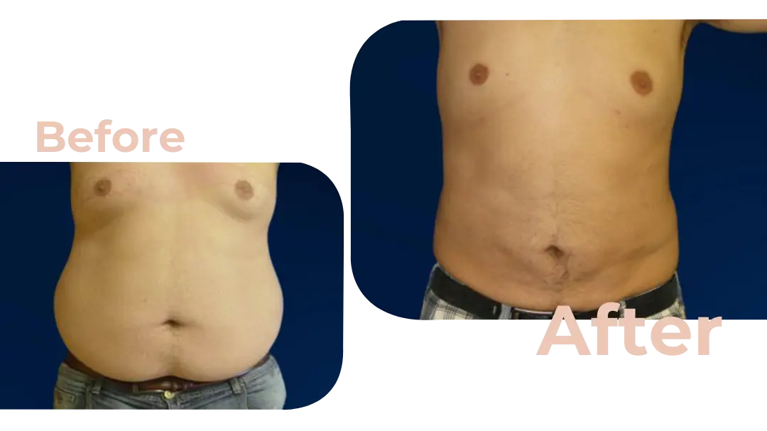 Tummy Tuck (Abdominoplasty) Surgery in Istanbul, Turkey by Avicenna Hospital