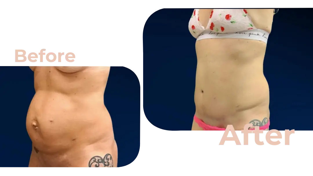 Tummy Tuck (Abdominoplasty) Surgery in Istanbul, Turkey by Avicenna Hospital