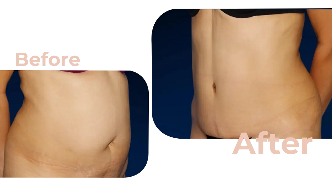 Tummy Tuck (Abdominoplasty) Surgery in Istanbul, Turkey by Avicenna Hospital