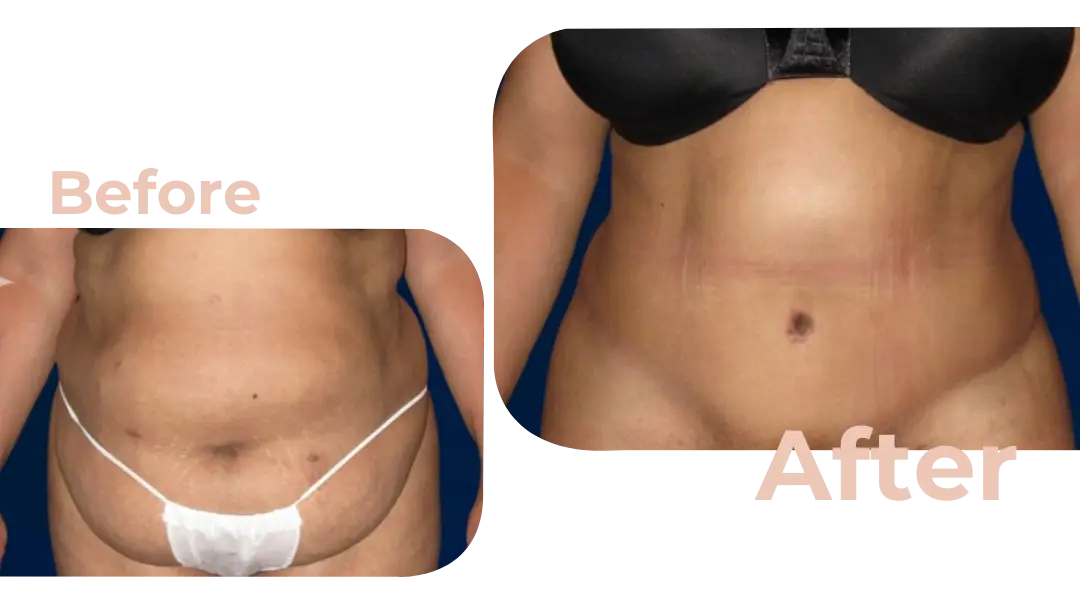 Tummy Tuck (Abdominoplasty) Surgery in Istanbul, Turkey by Avicenna Hospital