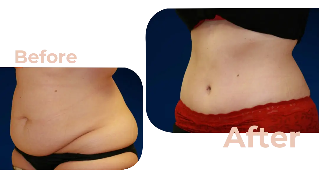 Tummy Tuck (Abdominoplasty) Surgery in Istanbul, Turkey by Avicenna Hospital
