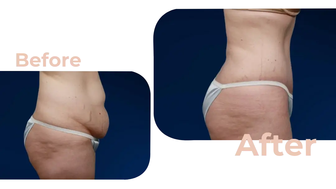 Tummy Tuck (Abdominoplasty) Surgery in Istanbul, Turkey by Avicenna Hospital
