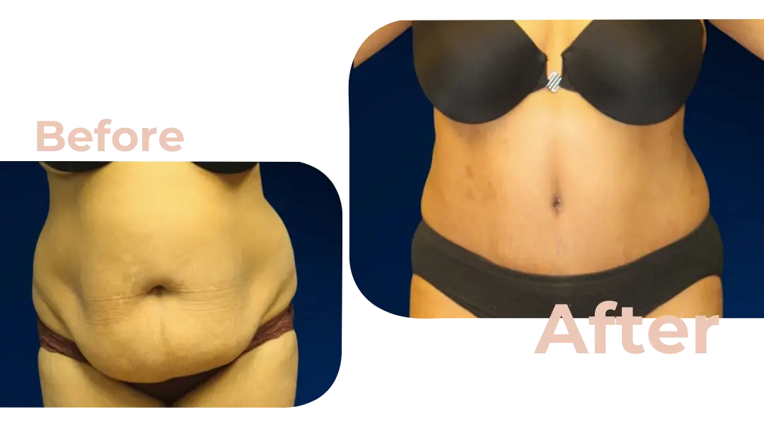 Tummy Tuck (Abdominoplasty) Surgery in Istanbul, Turkey by Avicenna Hospital