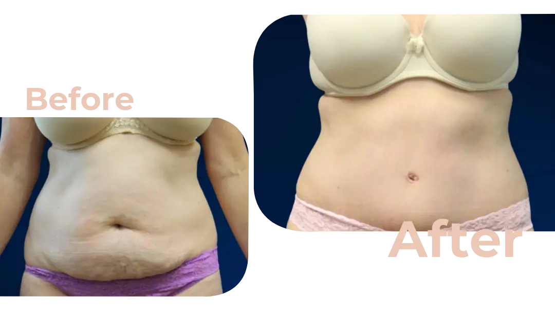 Tummy Tuck (Abdominoplasty) Surgery in Istanbul, Turkey by Avicenna Hospital