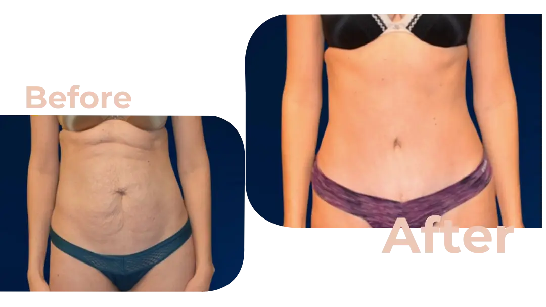 Tummy Tuck (Abdominoplasty) Surgery in Istanbul, Turkey by Avicenna Hospital