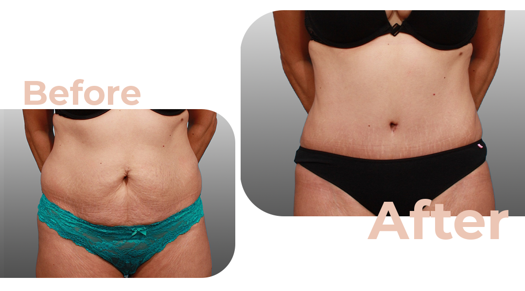 Tummy Tuck (Abdominoplasty) Surgery in Istanbul, Turkey by Avicenna Hospital