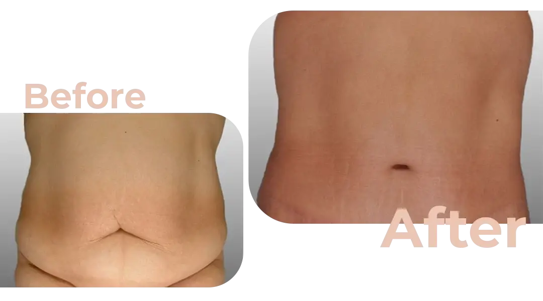 Tummy Tuck (Abdominoplasty) Surgery in Istanbul, Turkey by Avicenna Hospital