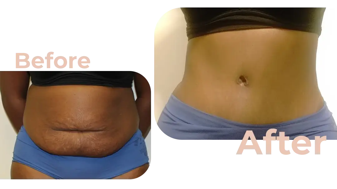 Tummy Tuck (Abdominoplasty) Surgery in Istanbul, Turkey by Avicenna Hospital