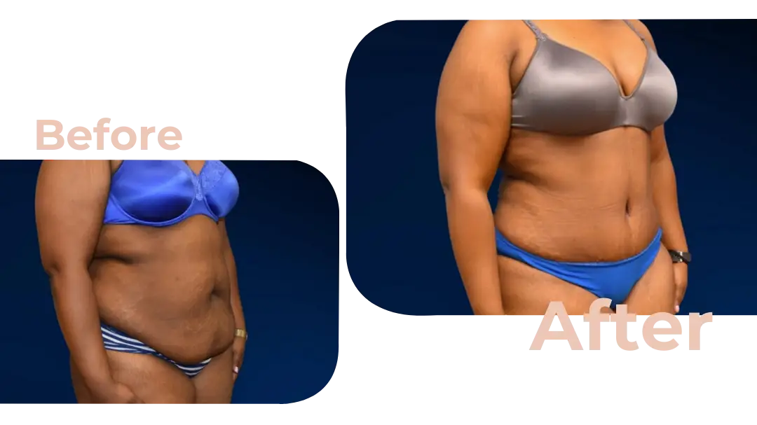 Tummy Tuck (Abdominoplasty) Surgery in Istanbul, Turkey by Avicenna Hospital