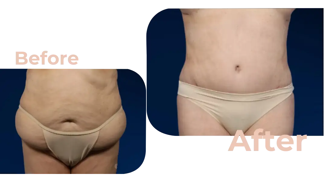 Tummy Tuck (Abdominoplasty) Surgery in Istanbul, Turkey by Avicenna Hospital