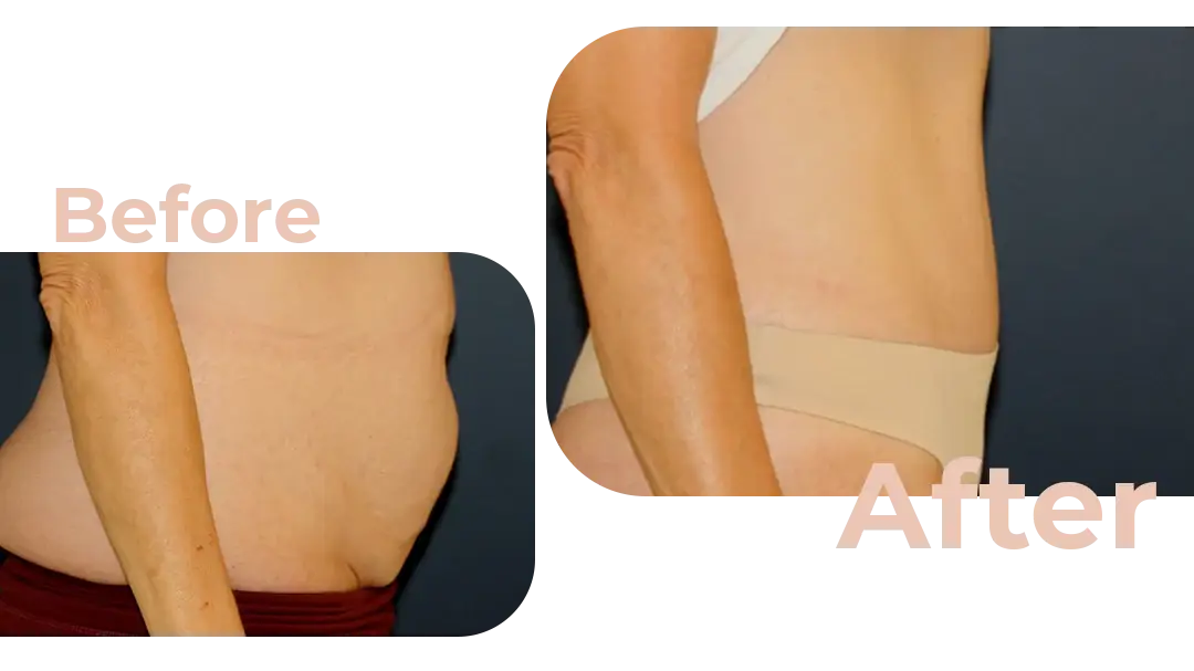 Tummy Tuck (Abdominoplasty) Surgery in Istanbul, Turkey by Avicenna Hospital