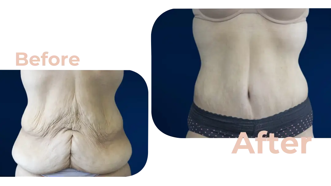 Tummy Tuck (Abdominoplasty) Surgery in Istanbul, Turkey by Avicenna Hospital