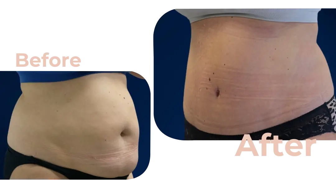 Tummy Tuck (Abdominoplasty) Surgery in Istanbul, Turkey by Avicenna Hospital