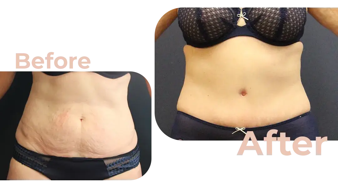 Tummy Tuck (Abdominoplasty) Surgery in Istanbul, Turkey by Avicenna Hospital