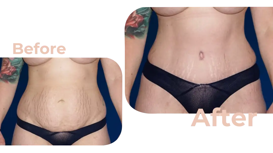 Tummy Tuck (Abdominoplasty) Surgery in Istanbul, Turkey by Avicenna Hospital