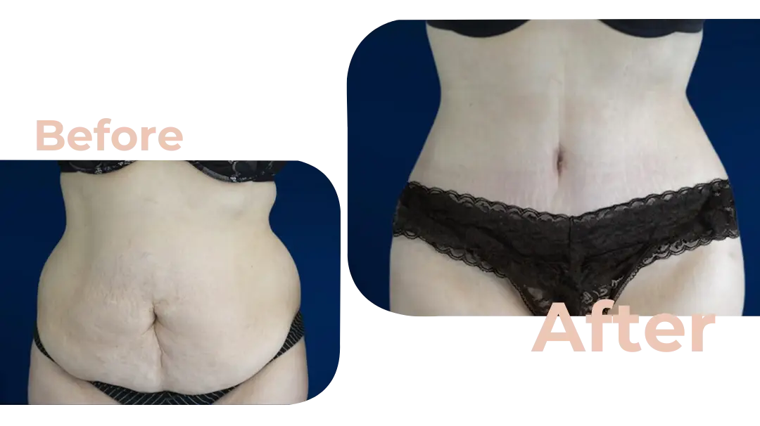 Tummy Tuck (Abdominoplasty) Surgery in Istanbul, Turkey by Avicenna Hospital