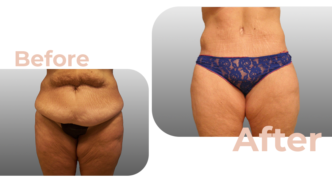 Tummy Tuck (Abdominoplasty) Surgery in Istanbul, Turkey by Avicenna Hospital