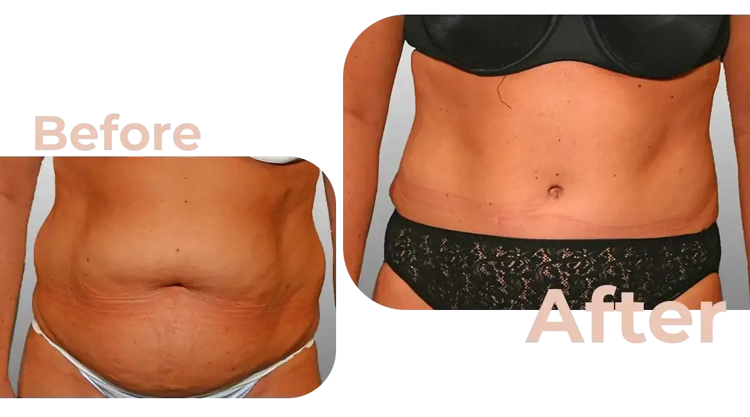 Tummy Tuck (Abdominoplasty) Surgery in Istanbul, Turkey by Avicenna Hospital