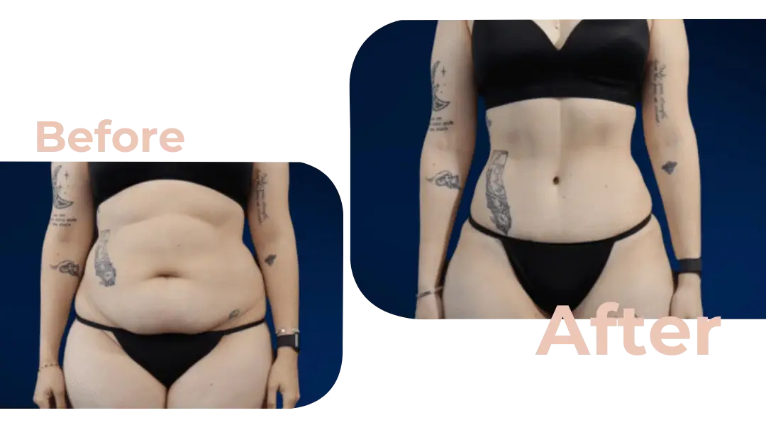 Tummy Tuck (Abdominoplasty) Surgery in Istanbul, Turkey by Avicenna Hospital
