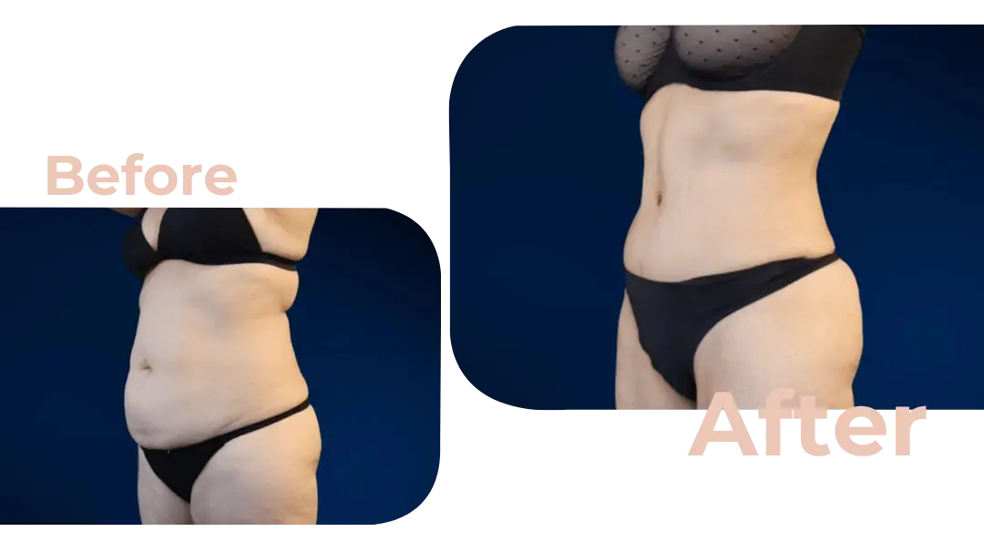 Tummy Tuck (Abdominoplasty) Surgery in Istanbul, Turkey by Avicenna Hospital