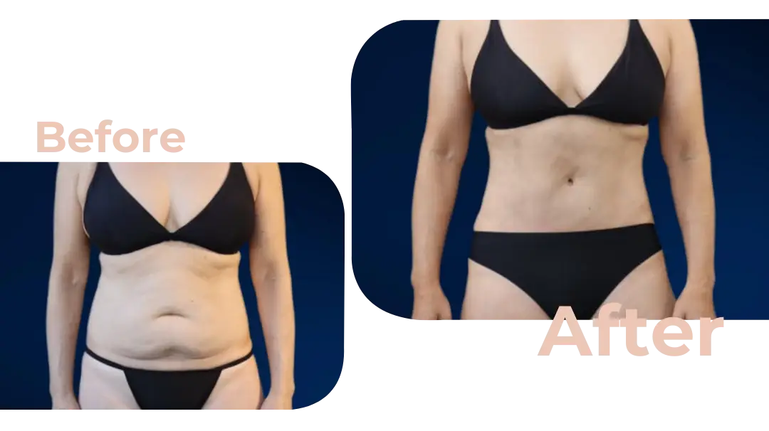 Tummy Tuck (Abdominoplasty) Surgery in Istanbul, Turkey by Avicenna Hospital