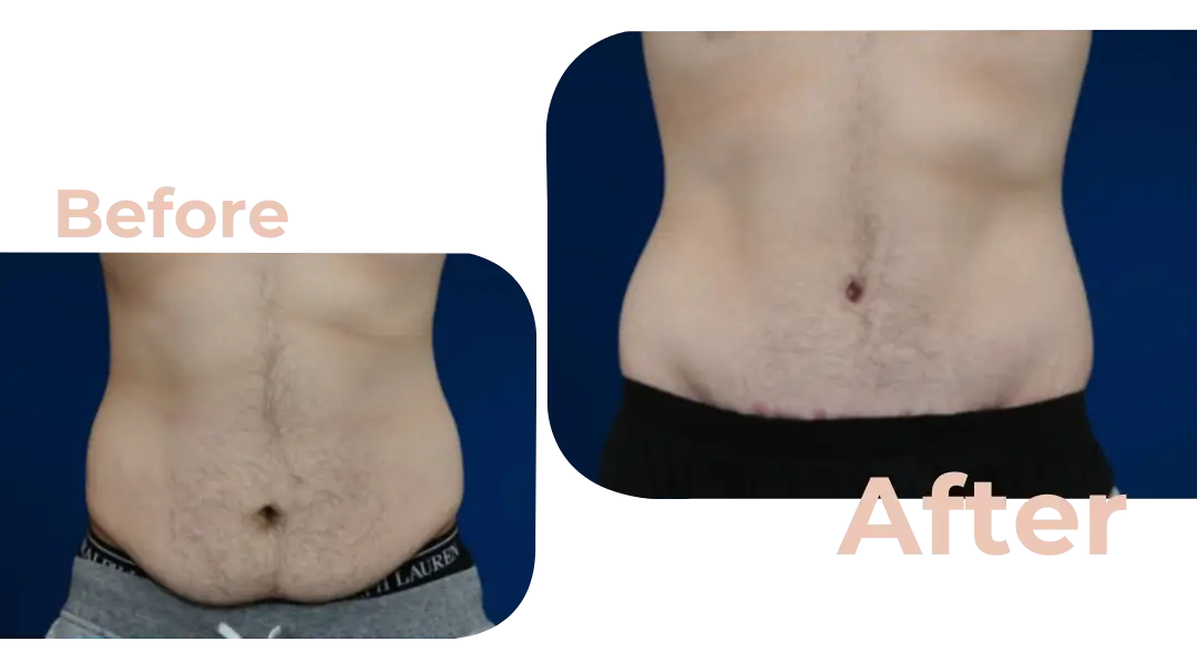 Tummy Tuck (Abdominoplasty) Surgery in Istanbul, Turkey by Avicenna Hospital