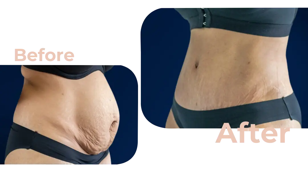 Tummy Tuck (Abdominoplasty) Surgery in Istanbul, Turkey by Avicenna Hospital