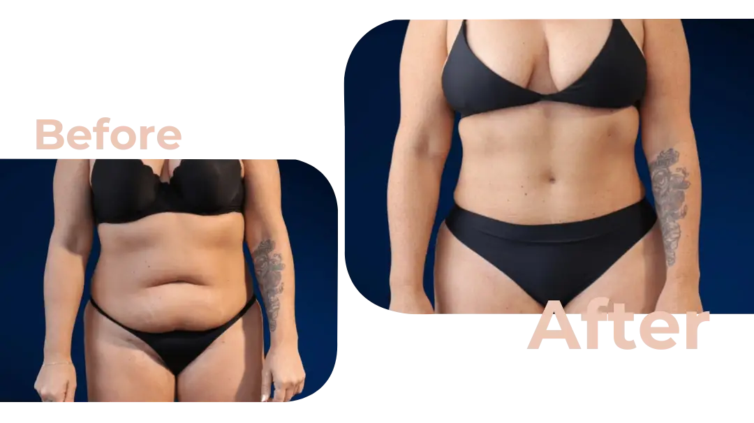 Tummy Tuck (Abdominoplasty) Surgery in Istanbul, Turkey by Avicenna Hospital