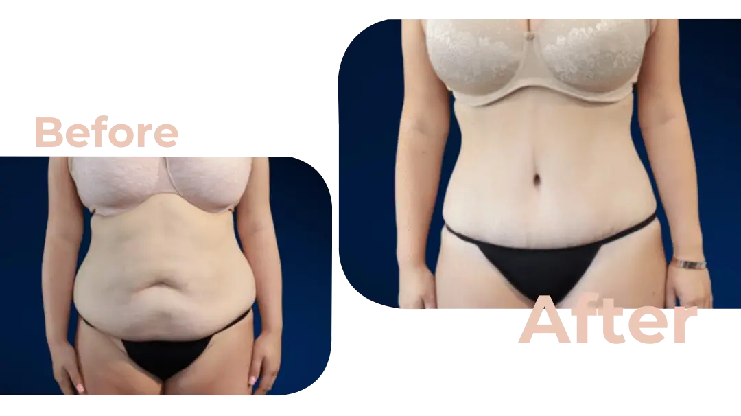 Tummy Tuck (Abdominoplasty) Surgery in Istanbul, Turkey by Avicenna Hospital