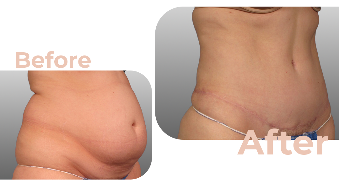 Tummy Tuck (Abdominoplasty) Surgery in Istanbul, Turkey by Avicenna Hospital