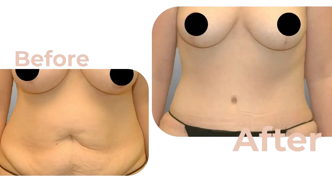 Tummy Tuck (Abdominoplasty) Surgery in Istanbul, Turkey by Avicenna Hospital