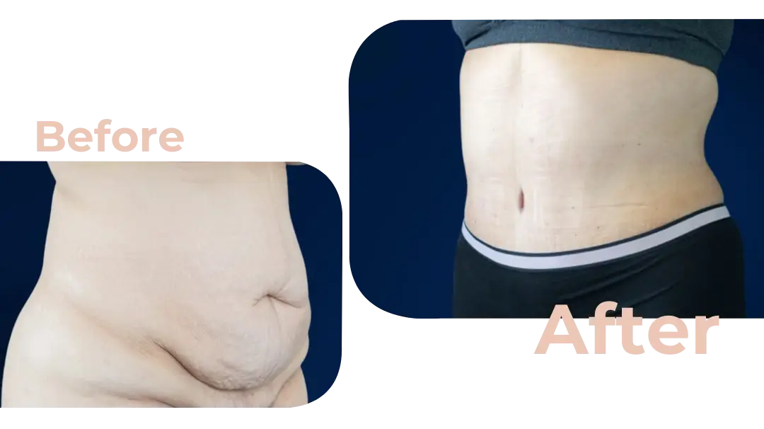 Tummy Tuck (Abdominoplasty) Surgery in Istanbul, Turkey by Avicenna Hospital