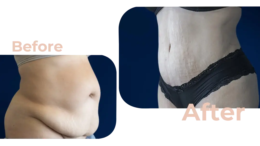 Tummy Tuck (Abdominoplasty) Surgery in Istanbul, Turkey by Avicenna Hospital