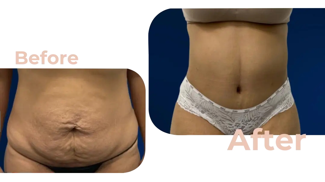 Tummy Tuck (Abdominoplasty) Surgery in Istanbul, Turkey by Avicenna Hospital
