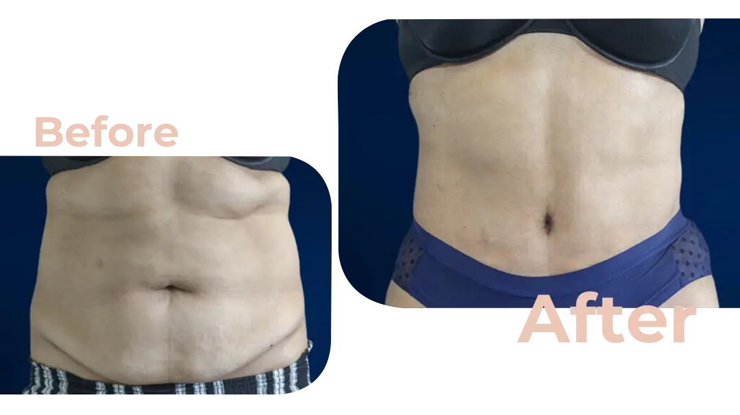 Tummy Tuck (Abdominoplasty) Surgery in Istanbul, Turkey by Avicenna Hospital