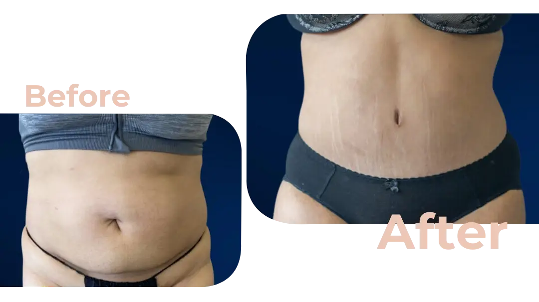 Tummy Tuck (Abdominoplasty) Surgery in Istanbul, Turkey by Avicenna Hospital