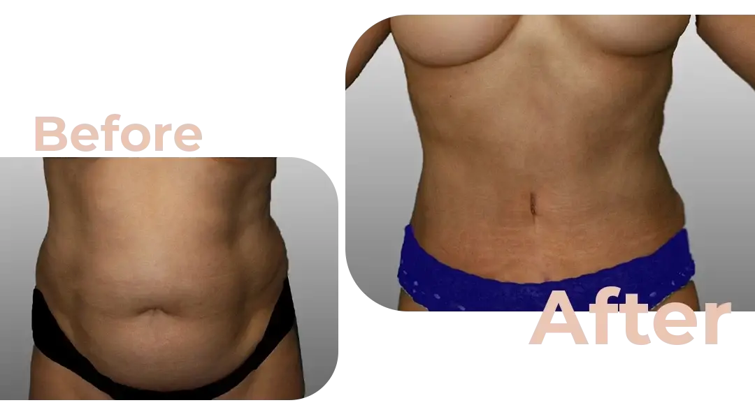 Tummy Tuck (Abdominoplasty) Surgery in Istanbul, Turkey by Avicenna Hospital