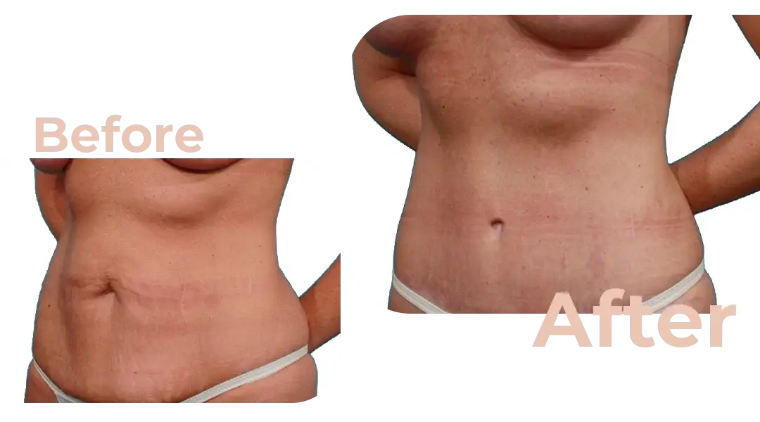 Tummy Tuck (Abdominoplasty) Surgery in Istanbul, Turkey by Avicenna Hospital
